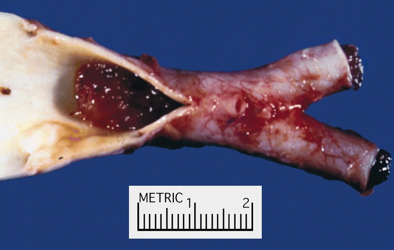 Egy leszakadt darabja elzr egy eret. Fot: The Armed Forces Institute of Pathology (AFIP) - PEIR Digital Library (Pathology image database). 